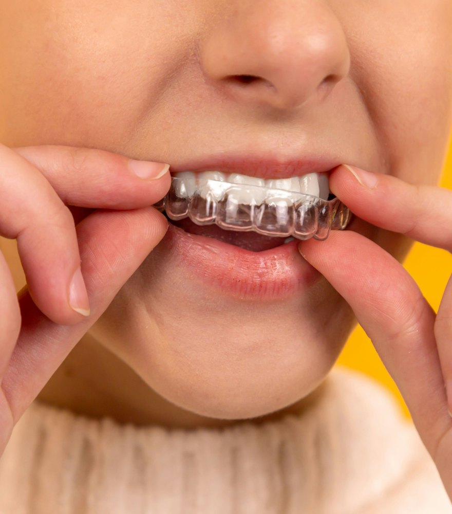 Paciente colocándose un alineador dental transparente